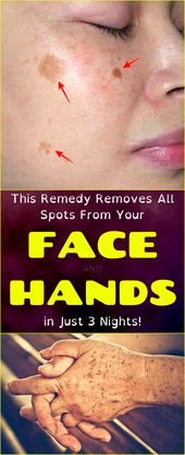 This Treatment Gets rid of Darkish Spots from Your Confront and Palms in Just 3 Evenings |